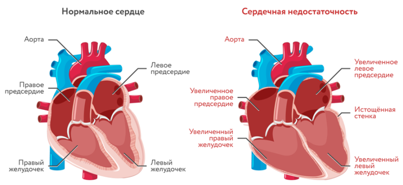 Что такое ХСН?